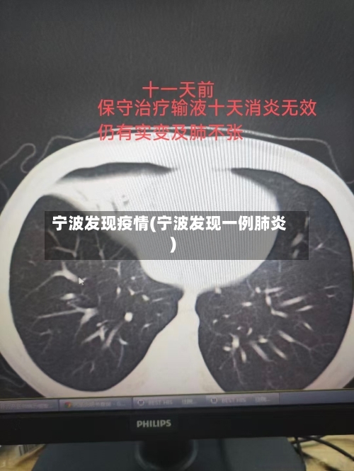 宁波发现疫情(宁波发现一例肺炎)-第1张图片