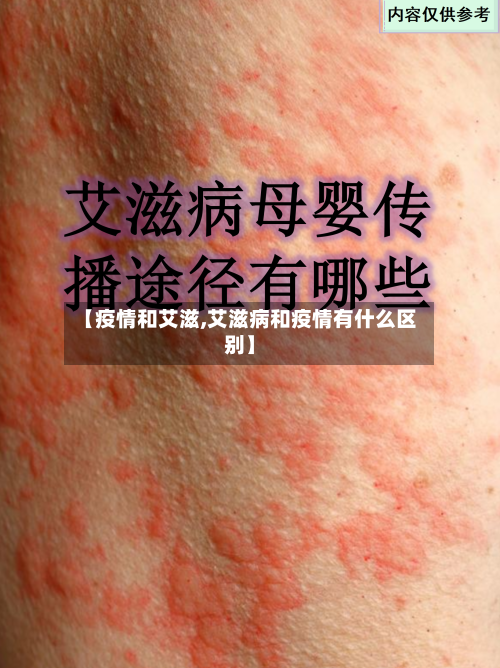 【疫情和艾滋,艾滋病和疫情有什么区别】-第2张图片