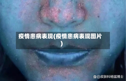 疫情患病表现(疫情患病表现图片)-第2张图片